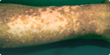 Image showing diffuse skin repigmentation pattern