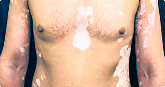 Image of a person with nonsegmental vitiligo