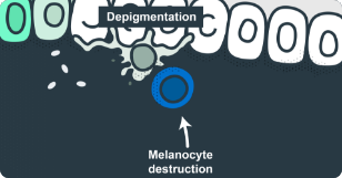 Image of T-cell-mediated melanocyte death, leading to depigmentation