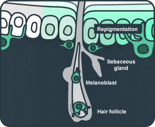 Image displaying the process of repigmentation