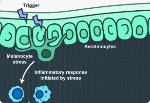 Image of an environmental trigger combined with genetic factors leading to melanocyte stress, causing an inflammatory response